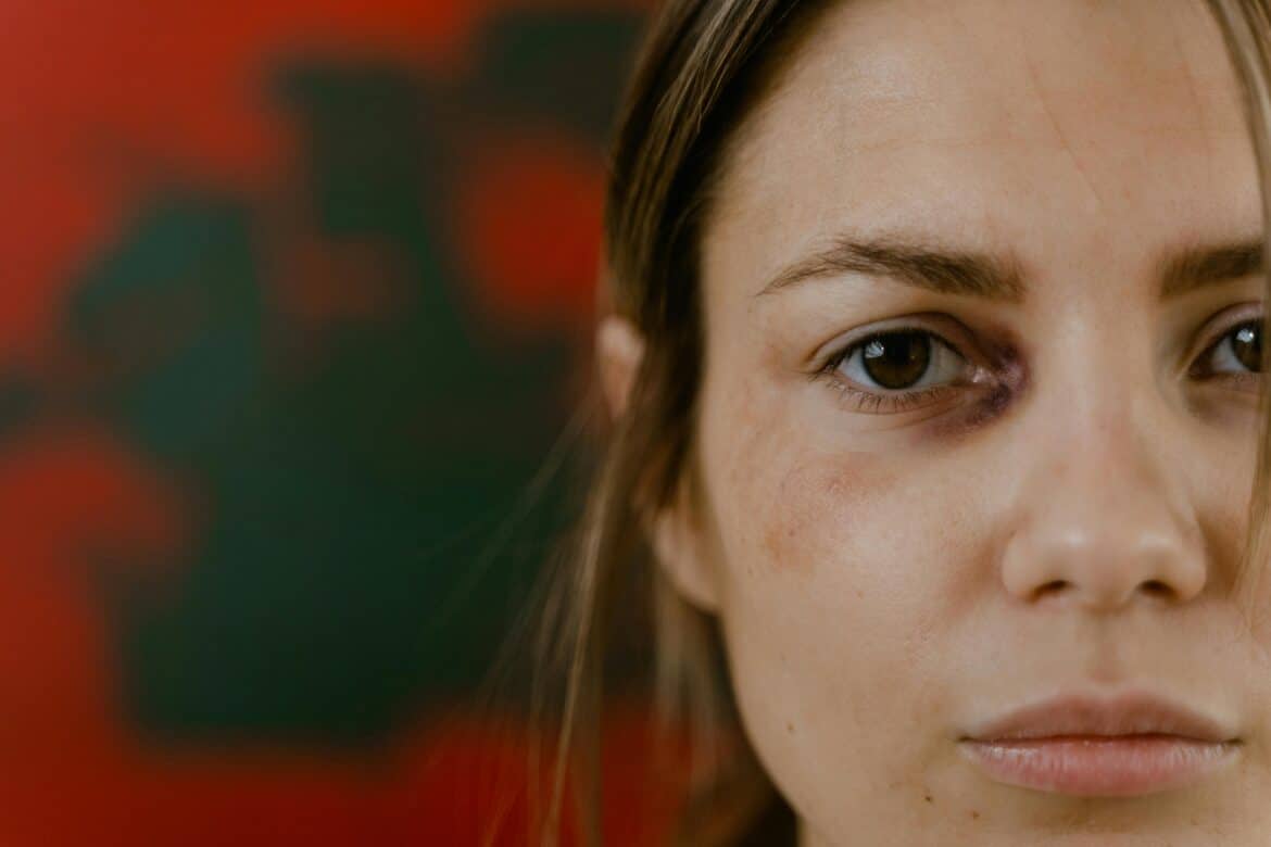 A close up shot of a woman with black eye